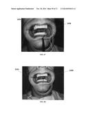 DENTAL OCCLUSION AND TENSION BAND TIES, SYSTEMS AND METHODS diagram and image