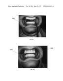 DENTAL OCCLUSION AND TENSION BAND TIES, SYSTEMS AND METHODS diagram and image