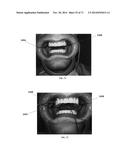 DENTAL OCCLUSION AND TENSION BAND TIES, SYSTEMS AND METHODS diagram and image