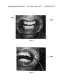 DENTAL OCCLUSION AND TENSION BAND TIES, SYSTEMS AND METHODS diagram and image