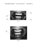 DENTAL OCCLUSION AND TENSION BAND TIES, SYSTEMS AND METHODS diagram and image