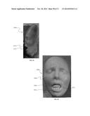 DENTAL OCCLUSION AND TENSION BAND TIES, SYSTEMS AND METHODS diagram and image