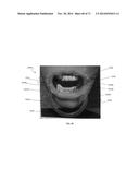 DENTAL OCCLUSION AND TENSION BAND TIES, SYSTEMS AND METHODS diagram and image