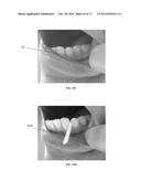 DENTAL OCCLUSION AND TENSION BAND TIES, SYSTEMS AND METHODS diagram and image