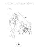 RETENTION OF A MAGNET IN A COCHLEAR IMPLANT diagram and image