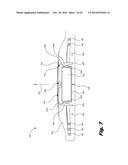 RETENTION OF A MAGNET IN A COCHLEAR IMPLANT diagram and image