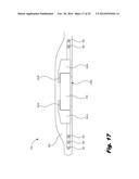 RETENTION OF A MAGNET IN A COCHLEAR IMPLANT diagram and image