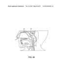 METHODS AND DEVICES FOR NON-INVASIVE CEREBRAL AND SYSTEMIC COOLING diagram and image