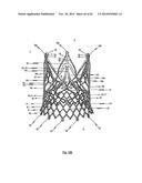 STENT FOR THE POSITIONING AND ANCHORING OF A VALVULAR PROSTHESIS IN AN     IMPLANTATION SITE IN THE HEART OF A PATIENT diagram and image