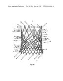 STENT FOR THE POSITIONING AND ANCHORING OF A VALVULAR PROSTHESIS IN AN     IMPLANTATION SITE IN THE HEART OF A PATIENT diagram and image