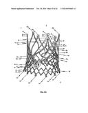 STENT FOR THE POSITIONING AND ANCHORING OF A VALVULAR PROSTHESIS IN AN     IMPLANTATION SITE IN THE HEART OF A PATIENT diagram and image