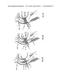 STENT FOR THE POSITIONING AND ANCHORING OF A VALVULAR PROSTHESIS IN AN     IMPLANTATION SITE IN THE HEART OF A PATIENT diagram and image