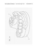 PROSTHODONTIC DEVICE diagram and image