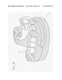 PROSTHODONTIC DEVICE diagram and image