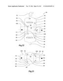 REMOVAL DEVICE diagram and image