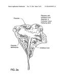 METHOD OF COLLECTING PLACENTAL STEM CELLS diagram and image