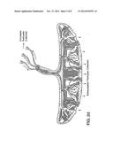 METHOD OF COLLECTING PLACENTAL STEM CELLS diagram and image