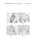 METHODS FOR TREATING BENIGN PROSTATIC HYPERTROPHY (BPH) diagram and image