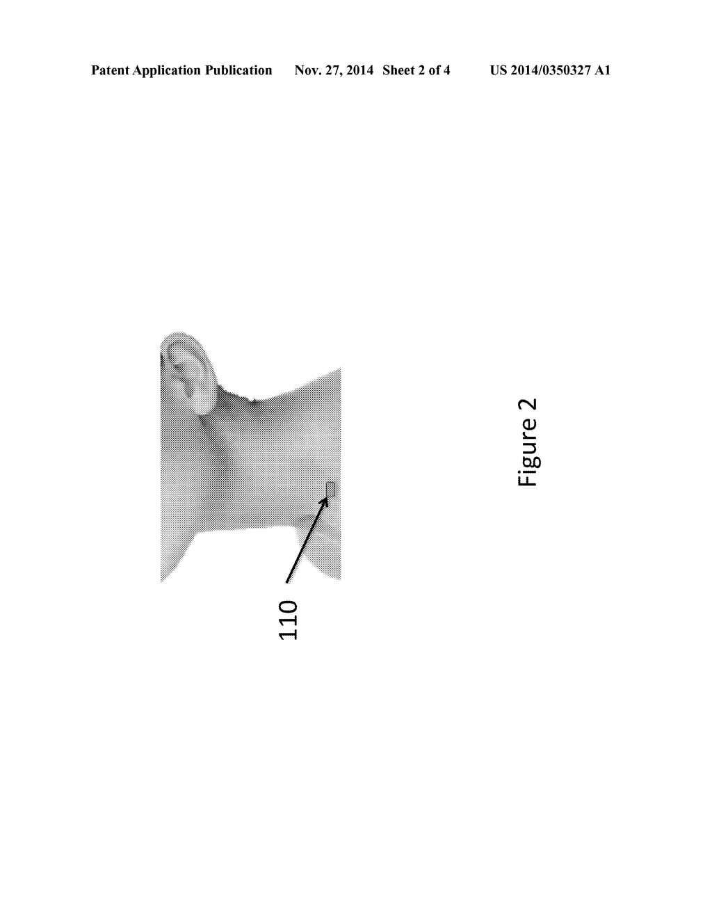 Device and method for interfering with sympathetic chain signaling for     attenuating hot flashes, post-traumatic stress disorder, pain and     dysautonomia - diagram, schematic, and image 03