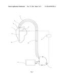 CATHETER TO ASSIST THE PERFORMANCE OF A HEART diagram and image