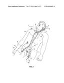 CAROTID BODY ABLATION VIA DIRECTED ENERGY diagram and image