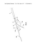 CAROTID BODY ABLATION VIA DIRECTED ENERGY diagram and image