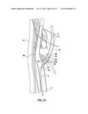 CAROTID BODY ABLATION VIA DIRECTED ENERGY diagram and image