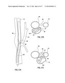 CAROTID BODY ABLATION VIA DIRECTED ENERGY diagram and image