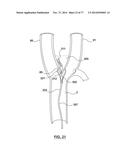 CAROTID BODY ABLATION VIA DIRECTED ENERGY diagram and image