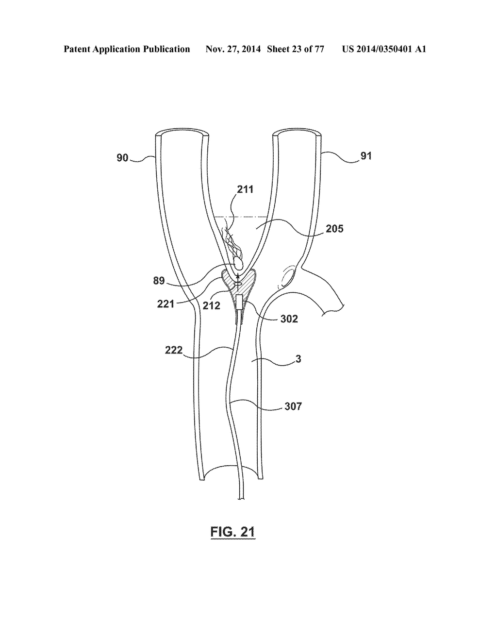 CAROTID BODY ABLATION VIA DIRECTED ENERGY - diagram, schematic, and image 24