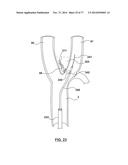 CAROTID BODY ABLATION VIA DIRECTED ENERGY diagram and image