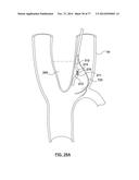 CAROTID BODY ABLATION VIA DIRECTED ENERGY diagram and image