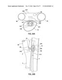 CAROTID BODY ABLATION VIA DIRECTED ENERGY diagram and image