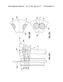 CAROTID BODY ABLATION VIA DIRECTED ENERGY diagram and image