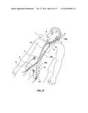 CAROTID BODY ABLATION VIA DIRECTED ENERGY diagram and image