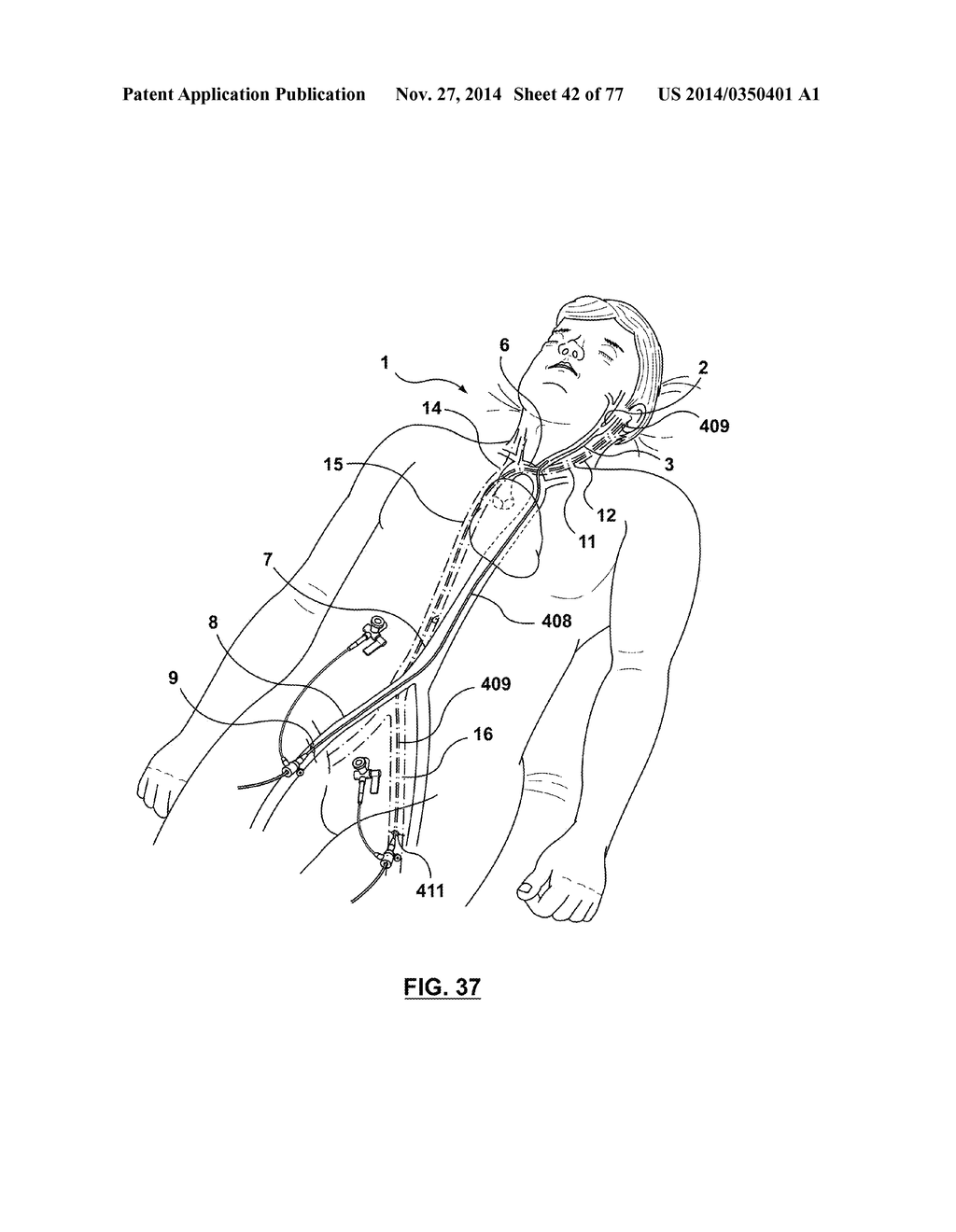 CAROTID BODY ABLATION VIA DIRECTED ENERGY - diagram, schematic, and image 43