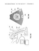 CAROTID BODY ABLATION VIA DIRECTED ENERGY diagram and image