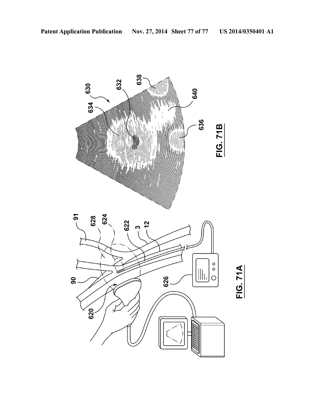 CAROTID BODY ABLATION VIA DIRECTED ENERGY - diagram, schematic, and image 78