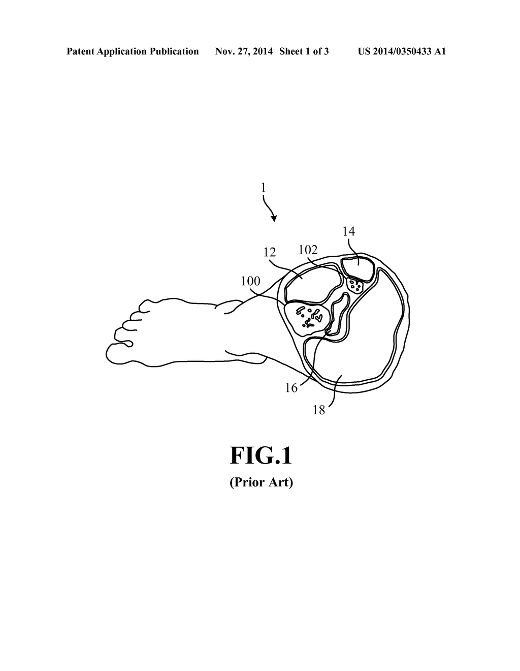 PRESSURE MEASURING DEVICE AND FIXING DEVICE WITH PRESSURE MEASURING     FUNCTION FOR AFFECTED PART - diagram, schematic, and image 02