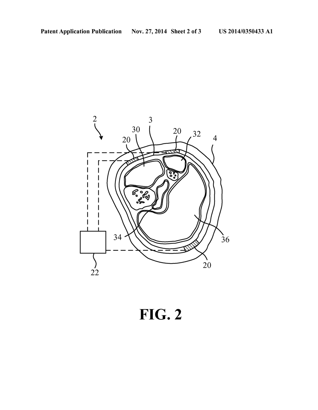 PRESSURE MEASURING DEVICE AND FIXING DEVICE WITH PRESSURE MEASURING     FUNCTION FOR AFFECTED PART - diagram, schematic, and image 03