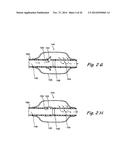 Devices and Methods for Delivering Therapeutic Substances for the     Treatment of Sinusitis and Other Disorders diagram and image