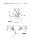 Devices and Methods for Delivering Therapeutic Substances for the     Treatment of Sinusitis and Other Disorders diagram and image