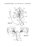 Devices and Methods for Delivering Therapeutic Substances for the     Treatment of Sinusitis and Other Disorders diagram and image