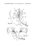 Devices and Methods for Delivering Therapeutic Substances for the     Treatment of Sinusitis and Other Disorders diagram and image