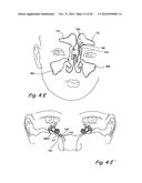 Devices and Methods for Delivering Therapeutic Substances for the     Treatment of Sinusitis and Other Disorders diagram and image