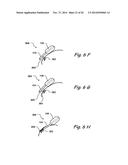 Devices and Methods for Delivering Therapeutic Substances for the     Treatment of Sinusitis and Other Disorders diagram and image