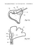 Devices and Methods for Delivering Therapeutic Substances for the     Treatment of Sinusitis and Other Disorders diagram and image