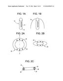 INTRAVESICAL DRUG DELIVERY DEVICE diagram and image