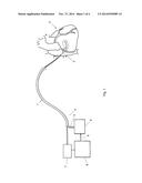 Method and Device for the Intermittent Occlusion of the Coronary Sinus diagram and image