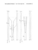 STENT AND OTHER OBJECT REMOVAL FROM A BODY diagram and image